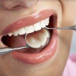 Co należy wiedzieć przed wyborem implantu zęba?