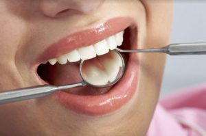Co należy wiedzieć przed wyborem implantu zęba?