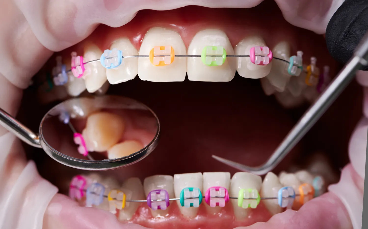 Co trzeba wiedzieć o implantach zębowych?