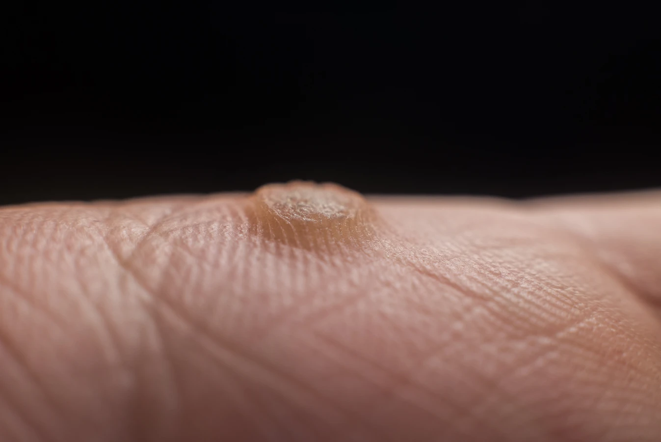 Jaskółcze ziele na kurzajki jak zrobić?